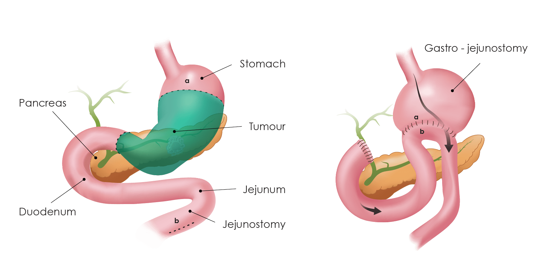 1.3.Gastrectomy partial withlegend