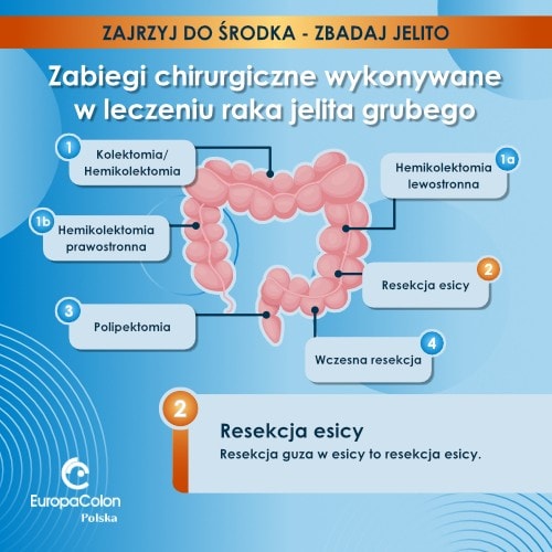 resekcja esicy